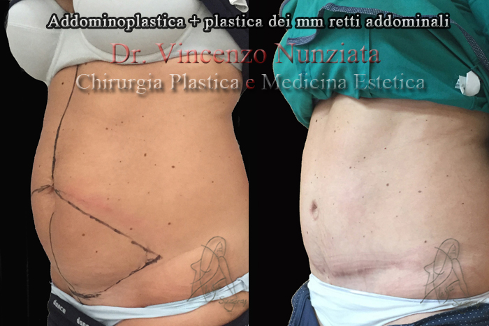 Addominoplastica prima e dopo – Paziente 7 – Dr. Vincenzo Nunziata, chirurgo plastico – foto 4