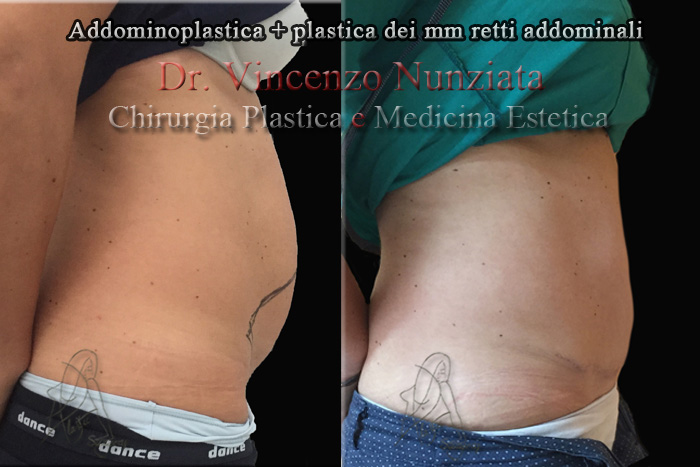 Addominoplastica prima e dopo – Paziente 7 – Dr. Vincenzo Nunziata, chirurgo plastico – foto 3