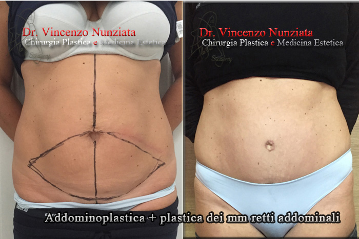 Addominoplastica prima e dopo – Paziente 7 – Dr. Vincenzo Nunziata, chirurgo plastico – foto 2