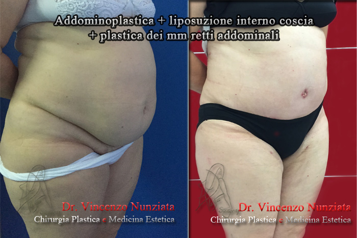 Addominoplastica prima e dopo – Paziente 8 – Dr. Vincenzo Nunziata, chirurgo plastico – foto 3