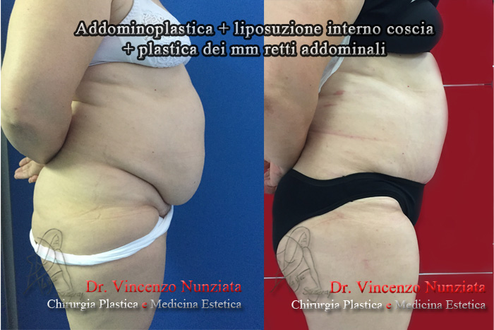 Addominoplastica prima e dopo – Paziente 8 – Dr. Vincenzo Nunziata, chirurgo plastico – foto 2