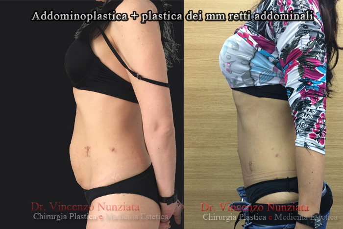 Addominoplastica prima e dopo – Paziente 5 – Dr. Vincenzo Nunziata, chirurgo plastico – foto 2