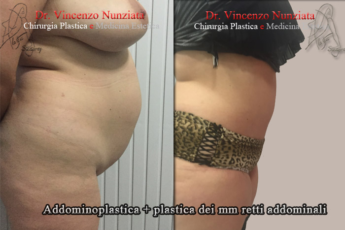 Addominoplastica prima e dopo – Paziente 6 – Dr. Vincenzo Nunziata, chirurgo plastico – foto 2
