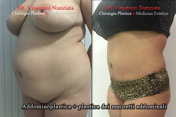 Addominoplastica prima e dopo – Paziente 6 – Dr. Vincenzo Nunziata, chirurgo plastico – foto 3