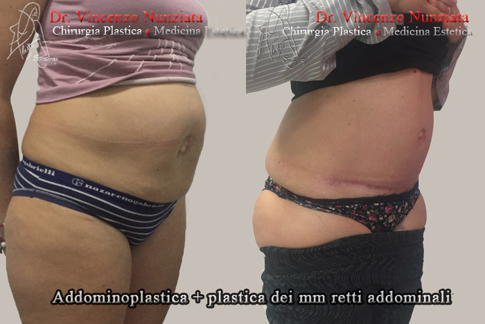 Addominoplastica prima e dopo – Paziente 11 – Dr. Vincenzo Nunziata, chirurgo plastico – foto 2