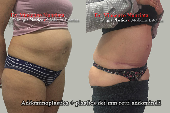 Addominoplastica prima e dopo – Paziente 11 – Dr. Vincenzo Nunziata, chirurgo plastico – foto 4