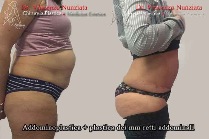Addominoplastica prima e dopo – Paziente 11 – Dr. Vincenzo Nunziata, chirurgo plastico – foto 3