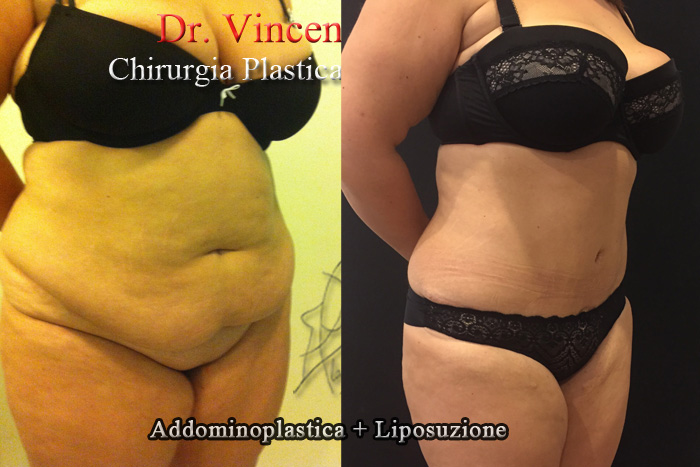 Addominoplastica prima e dopo – Paziente 4 – Dr. Vincenzo Nunziata, chirurgo plastico – foto 3