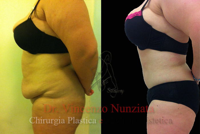 Addominoplastica prima e dopo – Paziente 4 – Dr. Vincenzo Nunziata, chirurgo plastico – foto 4
