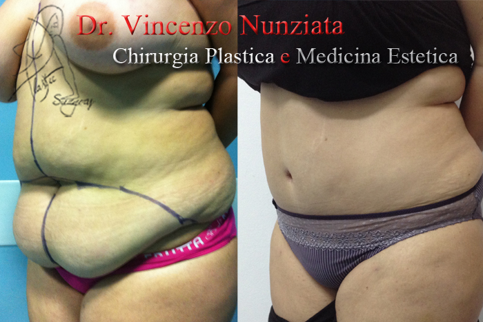 Addominoplastica prima e dopo – Paziente 9 – Dr. Vincenzo Nunziata, chirurgo plastico – foto 2