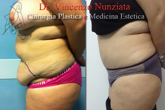 Addominoplastica prima e dopo – Paziente 9 – Dr. Vincenzo Nunziata, chirurgo plastico – foto 3