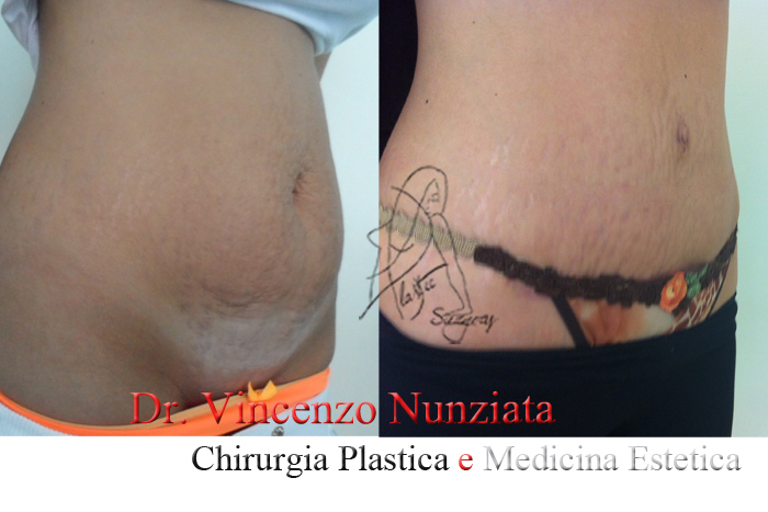 Addominoplastica prima e dopo – Paziente 10 – Dr. Vincenzo Nunziata, chirurgo plastico – foto 2