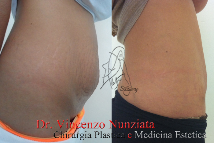 Addominoplastica prima e dopo – Paziente 10 – Dr. Vincenzo Nunziata, chirurgo plastico – foto 3