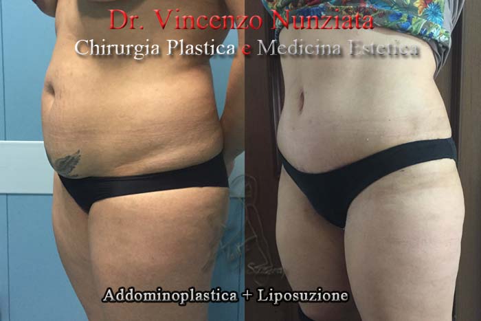 Addominoplastica prima e dopo – Paziente 3 – Dr. Vincenzo Nunziata, chirurgo plastico – foto 2