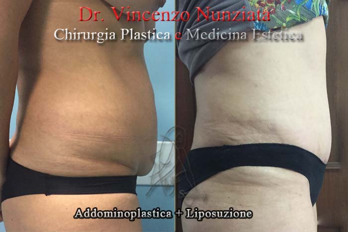 Addominoplastica prima e dopo – Paziente 3 – Dr. Vincenzo Nunziata, chirurgo plastico – foto 3