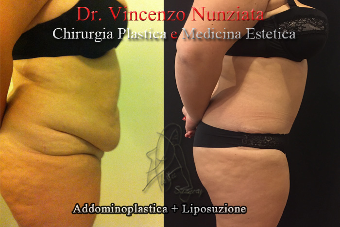 Addominoplastica prima e dopo – Paziente 4 – Dr. Vincenzo Nunziata, chirurgo plastico – foto 2