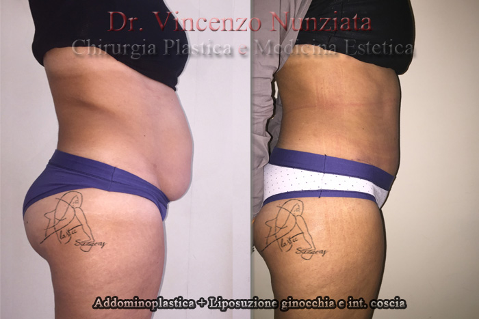 Addominoplastica prima e dopo – Paziente 2 – Dr. Vincenzo Nunziata, chirurgo plastico – foto 2
