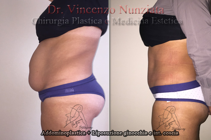 Addominoplastica prima e dopo – Paziente 2 – Dr. Vincenzo Nunziata, chirurgo plastico – foto 3