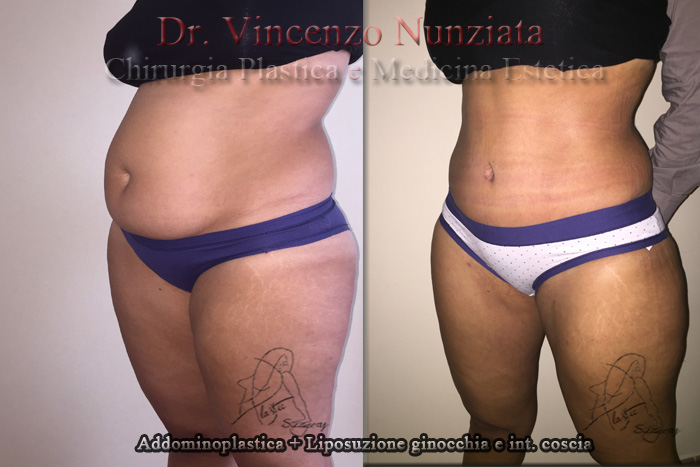 Addominoplastica prima e dopo – Paziente 2 – Dr. Vincenzo Nunziata, chirurgo plastico – foto 4