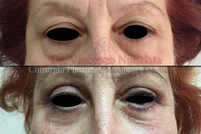 Blefaroplastica prima e dopo – Paziente 3 – Dr. Vincenzo Nunziata, chirurgo plastico – foto 1