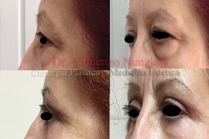 Blefaroplastica prima e dopo – Paziente 3 – Dr. Vincenzo Nunziata, chirurgo plastico – foto 2
