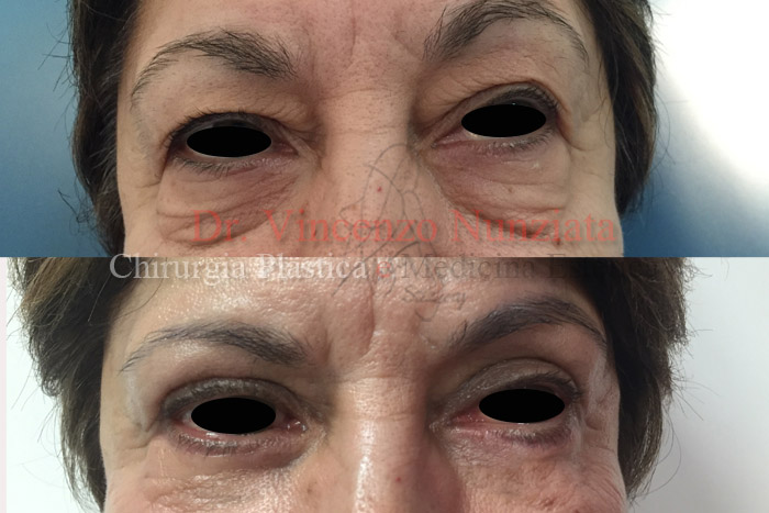 Blefaroplastica prima e dopo – Paziente 4 – Dr. Vincenzo Nunziata, chirurgo plastico – foto 1