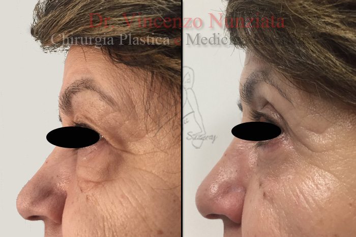 Blefaroplastica prima e dopo – Paziente 4 – Dr. Vincenzo Nunziata, chirurgo plastico – foto 2