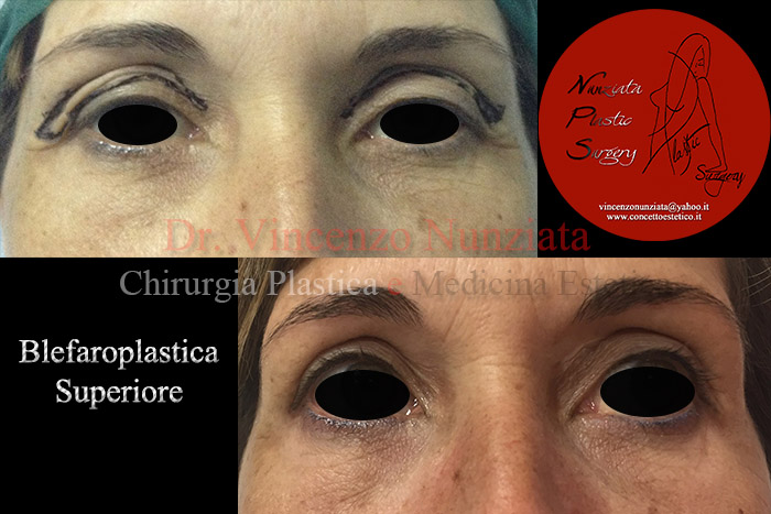 Blefaroplastica prima e dopo – Paziente 1 – Dr. Vincenzo Nunziata, chirurgo plastico – foto 1