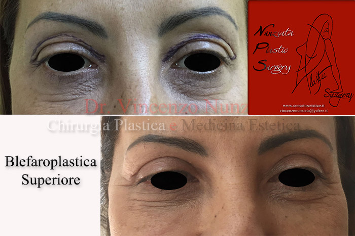 Blefaroplastica prima e dopo – Paziente 2 – Dr. Vincenzo Nunziata, chirurgo plastico – foto 1