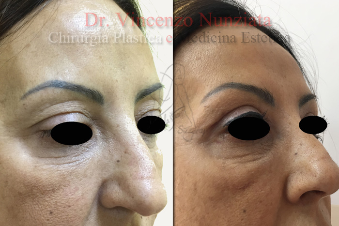 Blefaroplastica prima e dopo – Paziente 2 – Dr. Vincenzo Nunziata, chirurgo plastico – foto 2