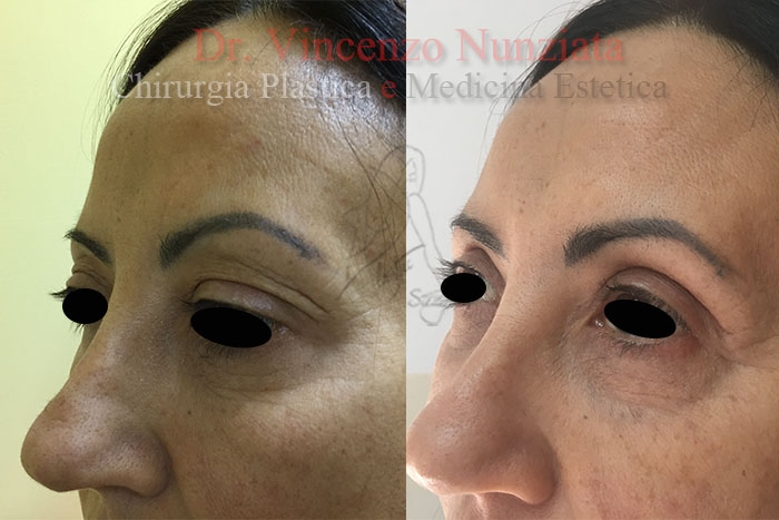Blefaroplastica prima e dopo – Paziente 2 – Dr. Vincenzo Nunziata, chirurgo plastico – foto 3