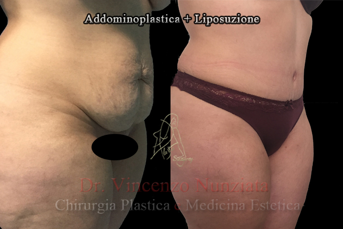 Addominoplastica prima e dopo – Paziente 1 – Dr. Vincenzo Nunziata, chirurgo plastico – foto 3