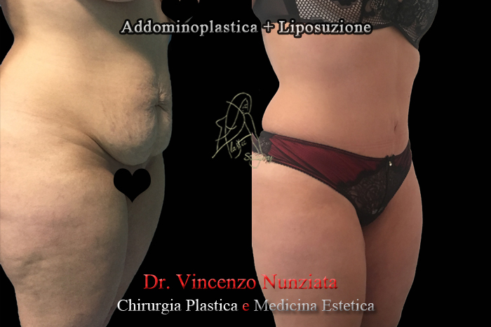 Addominoplastica prima e dopo – Paziente 1 – Dr. Vincenzo Nunziata, chirurgo plastico – foto 4