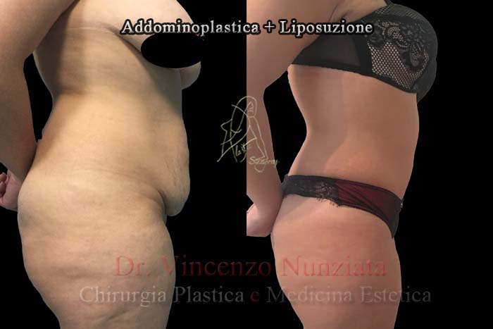 Addominoplastica prima e dopo – Paziente 1 – Dr. Vincenzo Nunziata, chirurgo plastico – foto 2