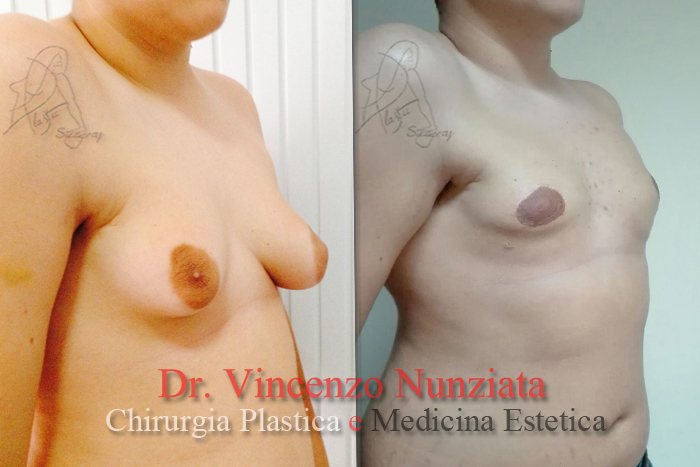Ginecomastia prima e dopo – Paziente 1 – Dr. Vincenzo Nunziata, chirurgo plastico – foto 3