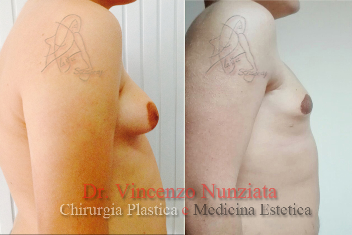 Ginecomastia prima e dopo – Paziente 1 – Dr. Vincenzo Nunziata, chirurgo plastico – foto 2