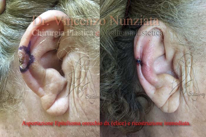 Chirurgia dei tumori cutanei prima e dopo – Tumori – Dr. Vincenzo Nunziata, chirurgo plastico – foto 3