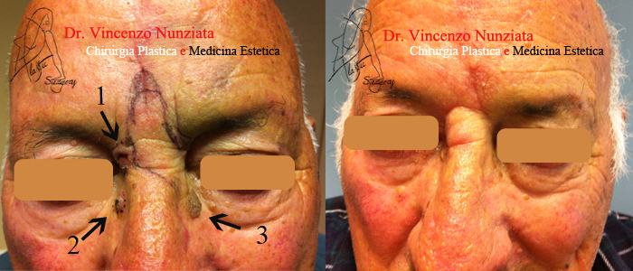 Chirurgia dei tumori cutanei prima e dopo – Tumori – Dr. Vincenzo Nunziata, chirurgo plastico – foto 2