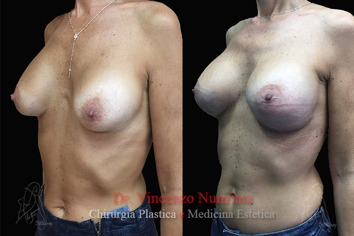 Revisioni mammarie prima e dopo – Paziente 2 – Dr. Vincenzo Nunziata, chirurgo plastico – foto 2