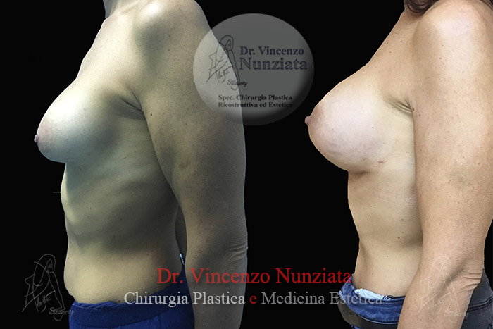 Revisioni mammarie prima e dopo – Paziente 2 – Dr. Vincenzo Nunziata, chirurgo plastico – foto 3