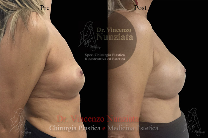 Revisioni mammarie prima e dopo – Paziente 1 – Dr. Vincenzo Nunziata, chirurgo plastico – foto 4