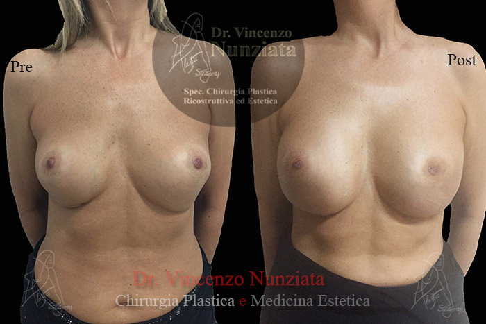 Revisioni mammarie prima e dopo – Paziente 1 – Dr. Vincenzo Nunziata, chirurgo plastico – foto 3