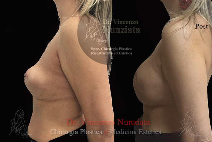 Revisioni mammarie prima e dopo – Paziente 1 – Dr. Vincenzo Nunziata, chirurgo plastico – foto 5