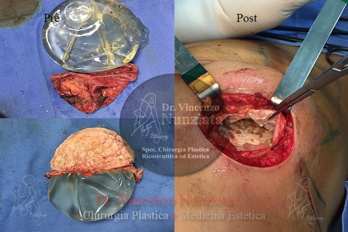 Revisioni mammarie prima e dopo – Paziente 1 – Dr. Vincenzo Nunziata, chirurgo plastico – foto 2