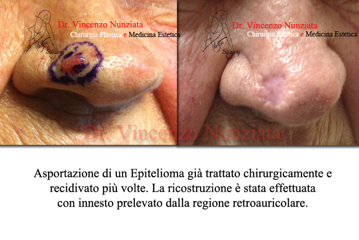 Chirurgia dei tumori cutanei prima e dopo – Tumori – Dr. Vincenzo Nunziata, chirurgo plastico – foto 4