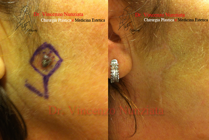 Chirurgia dei tumori cutanei prima e dopo – Tumori – Dr. Vincenzo Nunziata, chirurgo plastico – foto 5