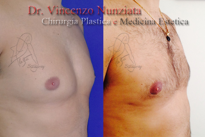 Ginecomastia prima e dopo – Paziente 3 – Dr. Vincenzo Nunziata, chirurgo plastico – foto 3