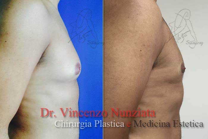 Ginecomastia prima e dopo – Paziente 3 – Dr. Vincenzo Nunziata, chirurgo plastico – foto 2