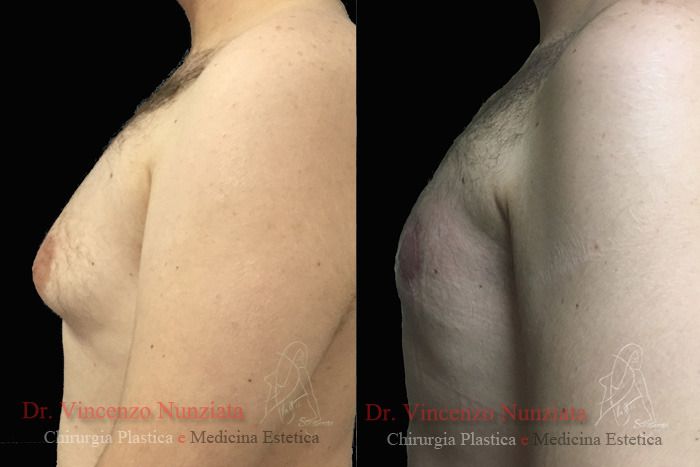 Ginecomastia prima e dopo – Paziente 4 – Dr. Vincenzo Nunziata, chirurgo plastico – foto 2
