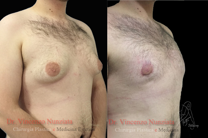 Ginecomastia prima e dopo – Paziente 4 – Dr. Vincenzo Nunziata, chirurgo plastico – foto 3